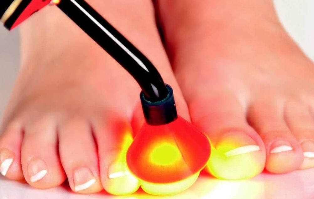 Laserbehandlung vun der Neel Plack