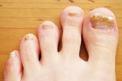 Nail filgus