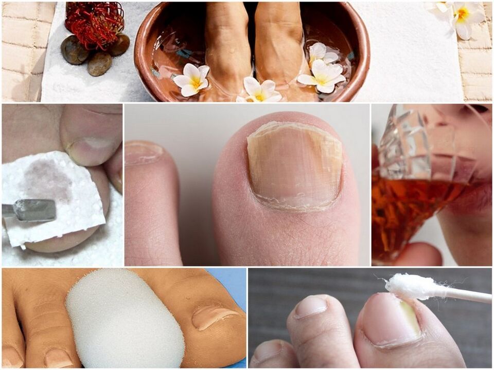 Nail filgus Behandlung